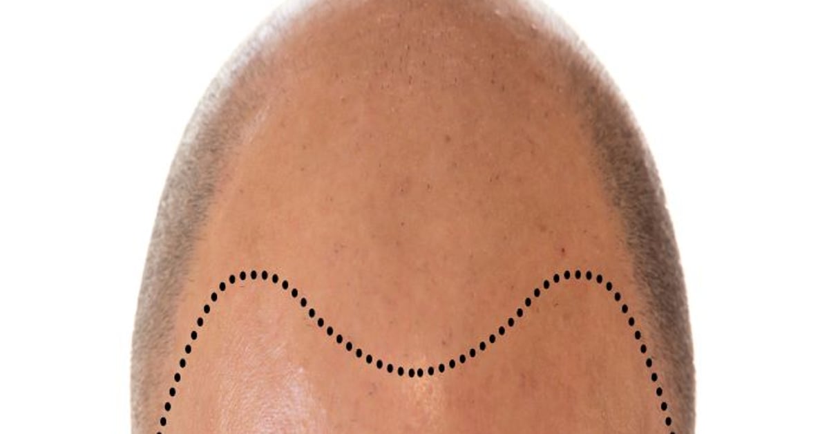 Greffe de cheveux les bonnes pratiques a adopter apres loperation featured